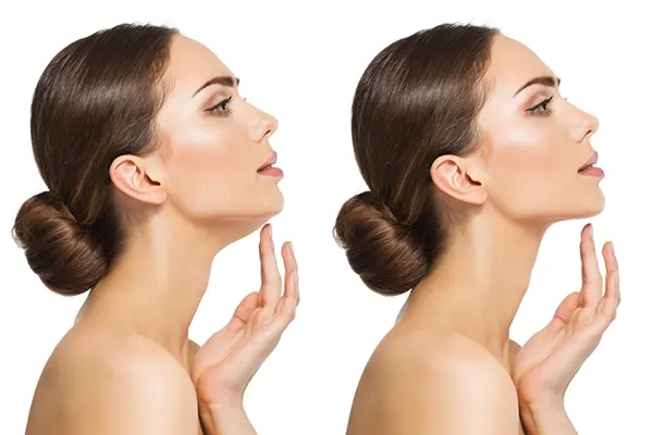 چه انتظاری پس از تزریق فیلر چانه داشته باشیم؟