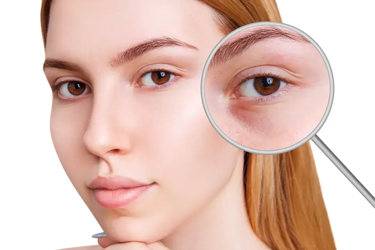 درمان گودی زیر چشم با فیلر هیالورونیک اسید