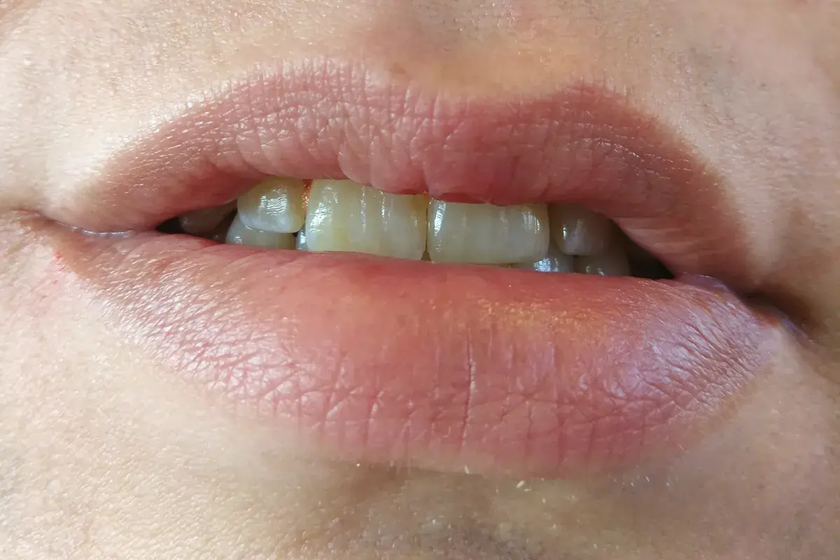 درمان عدم تقارن و ناهنجاریهای لب